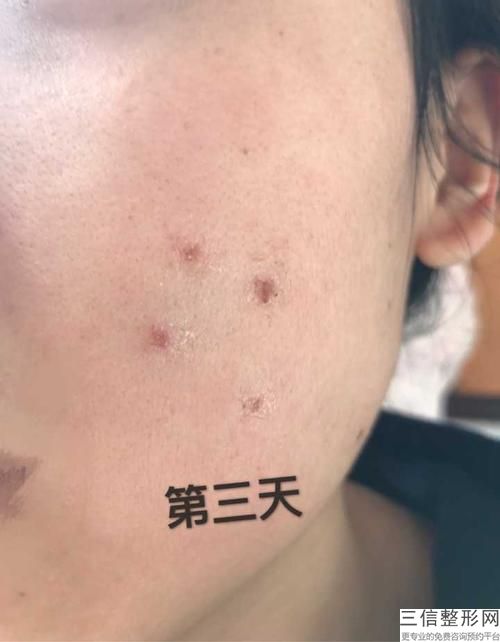連云港「重要分享」激光祛斑幾天恢復(fù)正常,—記者爆料，真相揭秘
