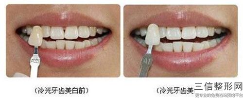 2023年深圳市德國(guó)卡瓦種植牙醫(yī)院排名前十佳哪幾家更好-深圳市德國(guó)卡瓦種植牙口腔醫(yī)院