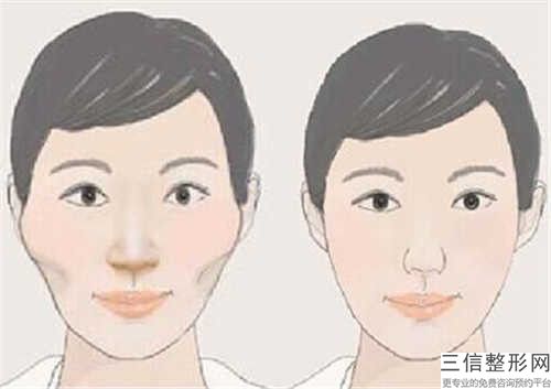 秦皇島市磨完顴骨整形醫院排行榜前十佳新版推薦(秦皇島如畫醫療美容診所拿下前三甲)