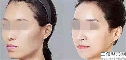 廣州3d面部提升的價格都是多少