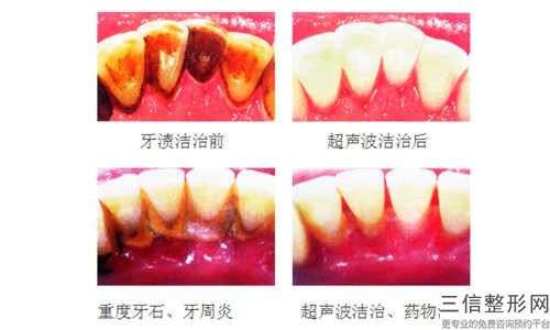 北海鑲牙牙冠后并發(fā)癥應(yīng)該如何處理