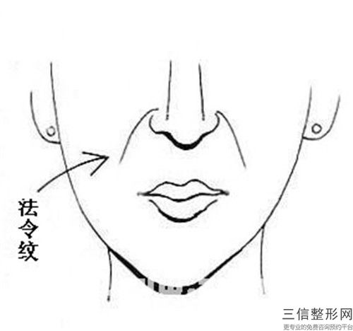 除皺針去川字紋對(duì)懷孕會(huì)有影響嗎