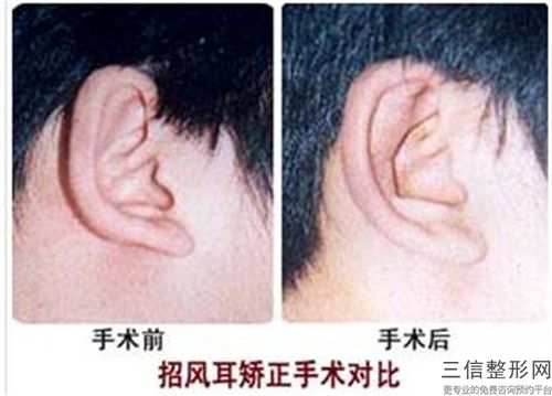 人的耳畸形可能出現哪些副作用嗎