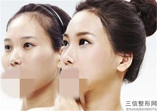 李志海醫(yī)生顴弓內(nèi)推下頜角案例-價(jià)位表超全速看