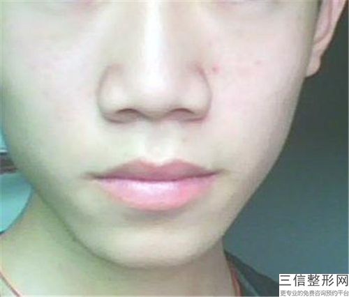 整形鼻基底肋軟骨填充醫(yī)院推薦：鼻基底肋軟骨填充醫(yī)院前30佳都是好口碑醫(yī)