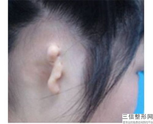 哪醫(yī)院做再造耳廓推薦：再造耳廓醫(yī)院前30名紅榜出爐