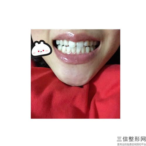 遼源美學修復前牙齒后是否會影響嗅覺