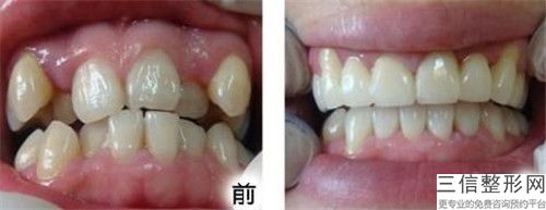 莆田上牙微創種牙的副作用禁忌癥