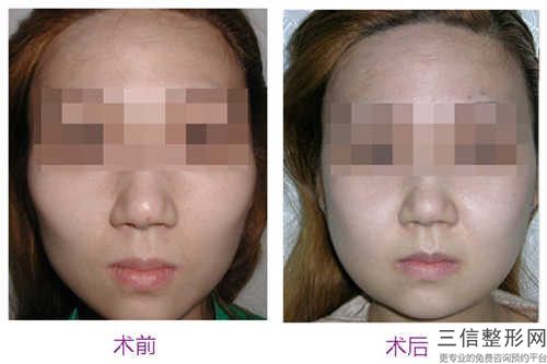 廊坊后牙槽骨頭突出術后會有后遺癥的發生嗎