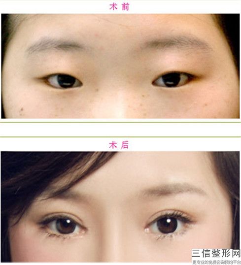 承德高度近視眼術(shù)后副作用-承德高度近視眼副作用大不大呢