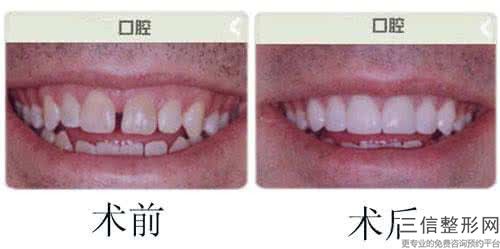 白城假牙純鈦支架整形手術(shù)比較好的年齡段