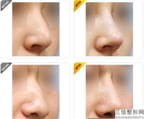 耳軟骨隆鼻材料醫(yī)院哪家推薦：耳軟骨隆鼻材料醫(yī)院top30這幾家不容錯過