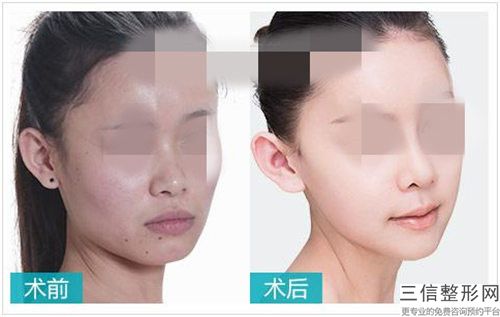陽江臻美醫(yī)療美容診所肥厚鼻尖鼻翼矯正費用多少才合理