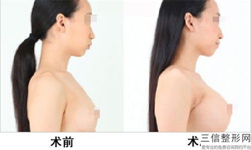 黃良飛PIP隆胸假體手術有隱患嗎