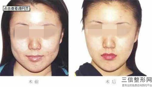 毛新萍醫生去除顴弓案例-價位表公開