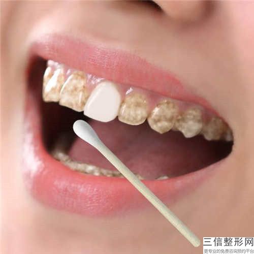 保定發業醫療美容診所美學修復前牙齒手術安全可靠