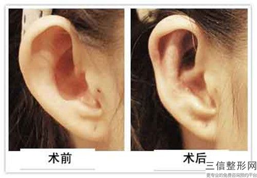 衡水顏美醫療美容診所手術再造耳安全嗎,有沒有副作用