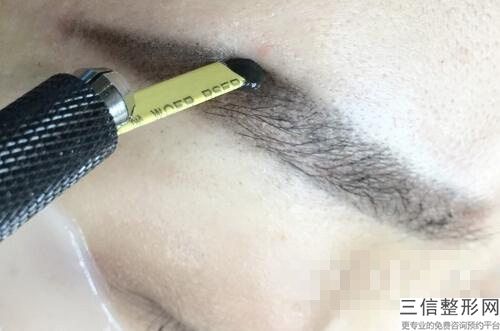 楊永成種植眉毛后會不會有副作用呢