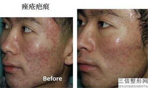 鐳射去痘印后有哪些功效