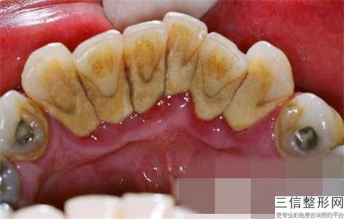 六安修牙牙齦比較安全的方法(六安修牙牙齦手術的安全性好不)