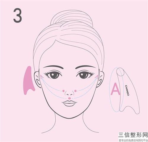 面部玻尿酸注射除皺整形后會(huì)留下后遺癥嗎