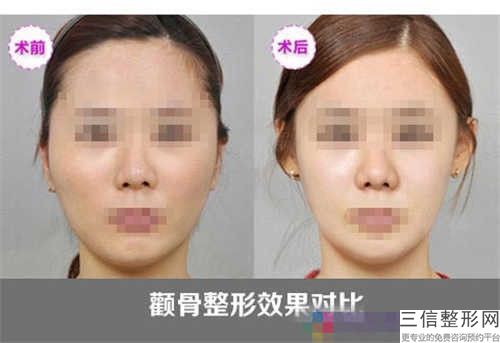 江門市用手推顴骨醫生排名這10個醫生才是真的火-劉真俊醫生陳曉蕊口碑一頂一的好