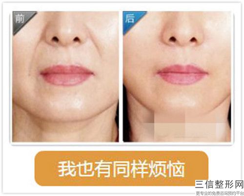 恩施中韓整形美容醫(yī)院電波除皺拉皮術(shù)的安全性與什么有關(guān)
