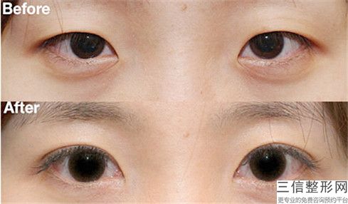 宋影醫生藥物去除黑眼圈TOP10上榜理由公開-亳州市人民醫院美容科