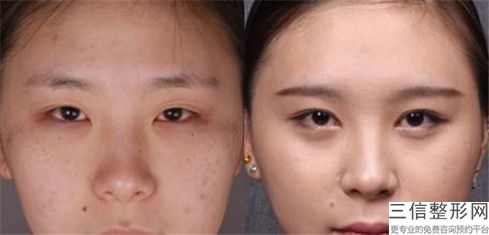 湛江矯正近視框架眼鏡術會有什么后遺癥