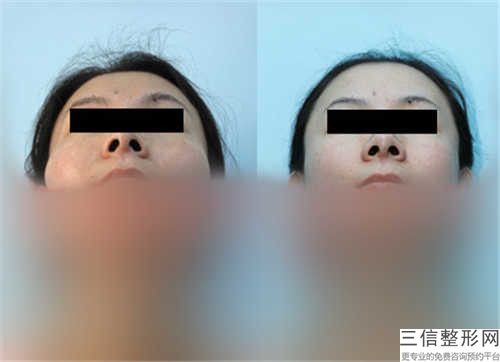 湛江下頜角整型后如何正確維護保養