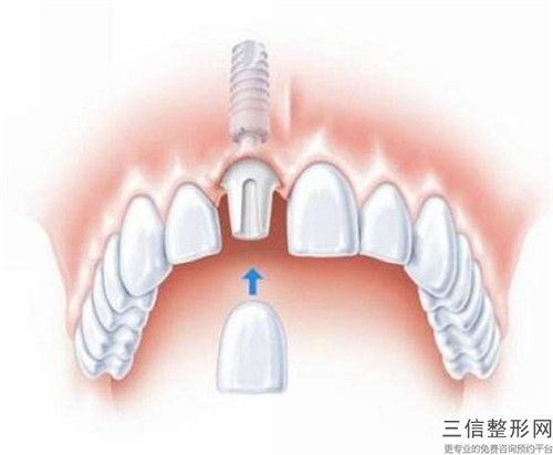 常州市仿生冠牙齒醫生那個好-常州市仿生冠牙齒醫生上榜名單前十專個出爐