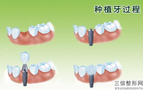 根尖牙周炎術后修復影響工作嗎
