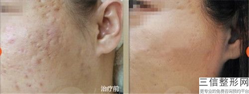 陳宏宇醫生獸皮痣祛除值得選-柳州市人民醫院