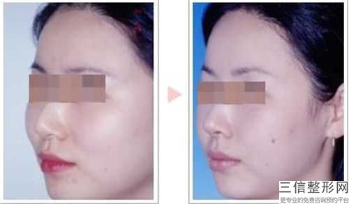 全國t字截骨術良好的醫院是哪家：t字截骨術醫院前50佳熱門推薦