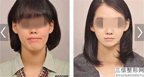 柳州整形兔唇手術拆線后怎樣護理