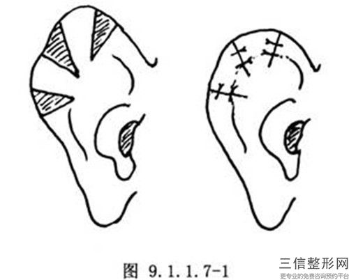 青海省好的耳朵矯正手術醫院推薦：耳朵矯正手術醫院前30名正規總結