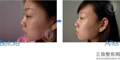 周倫梅整形醫(yī)生-貴州省周倫梅醫(yī)生激光點(diǎn)痣比知名連鎖實(shí)力靠譜