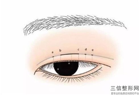 男生雙眼皮的手術方法及風險,男生雙眼皮會不會危害到身體健康呢